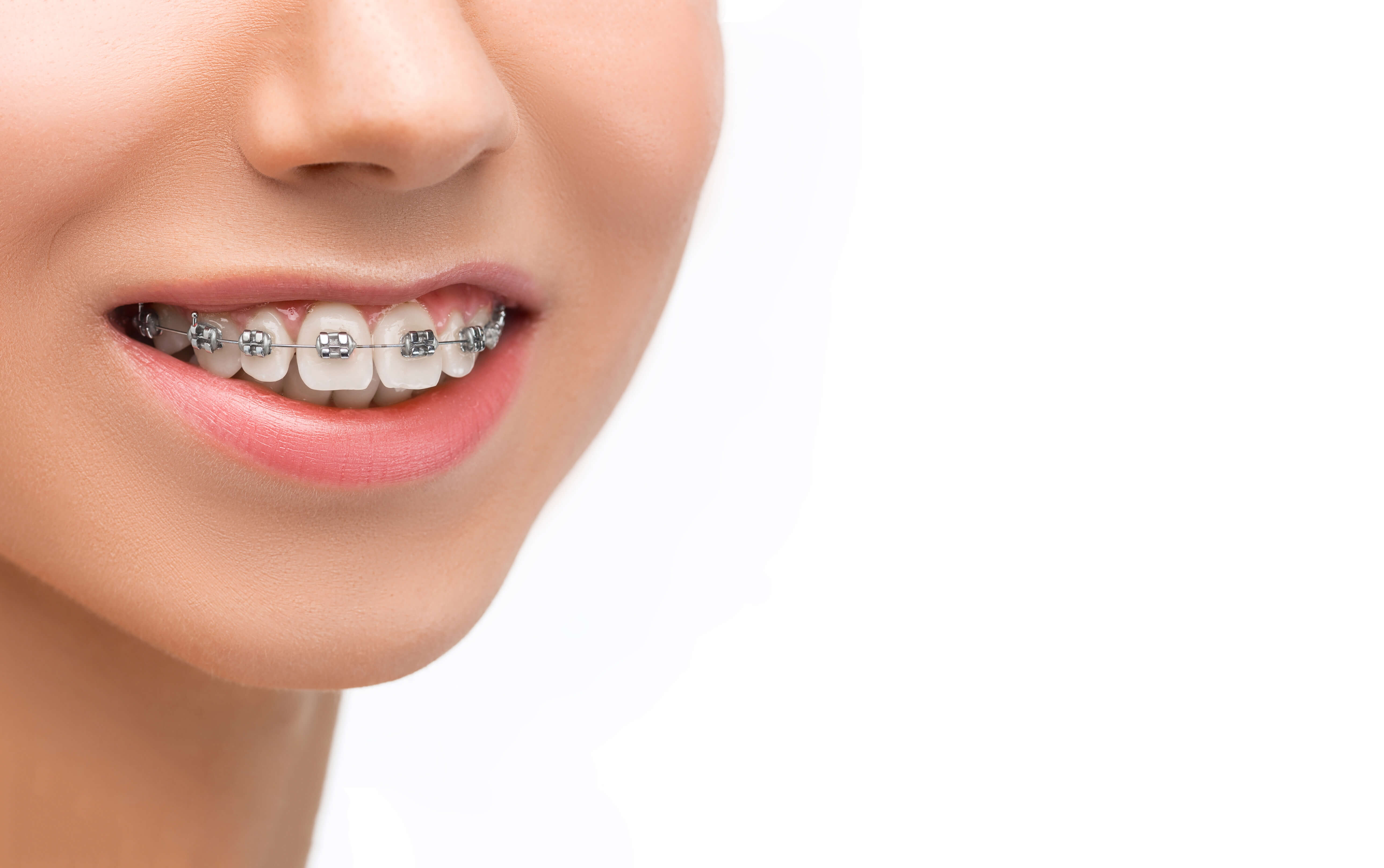 beautiful-young-woman-with-teeth-braces_1